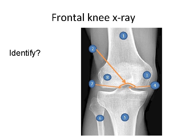 Frontal knee x-ray 1 Identify? 2 3 8 7 4 6 5 