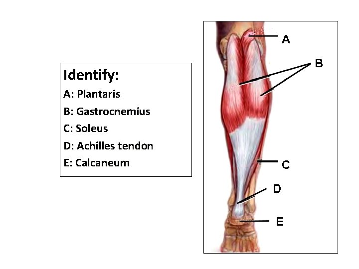 A B Identify: A: Plantaris B: Gastrocnemius C: Soleus D: Achilles tendon E: Calcaneum