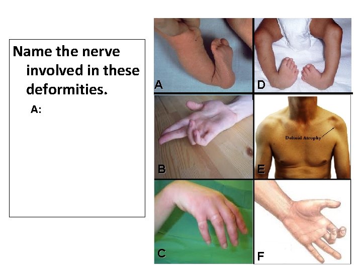 Name the nerve involved in these deformities. A D B E C F A: