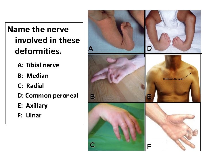 Name the nerve involved in these deformities. A: Tibial nerve B: Median C: Radial