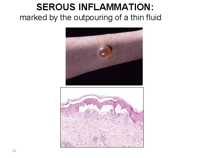 SEROUS INFLAMMATION: marked by the outpouring of a thin fluid 10 