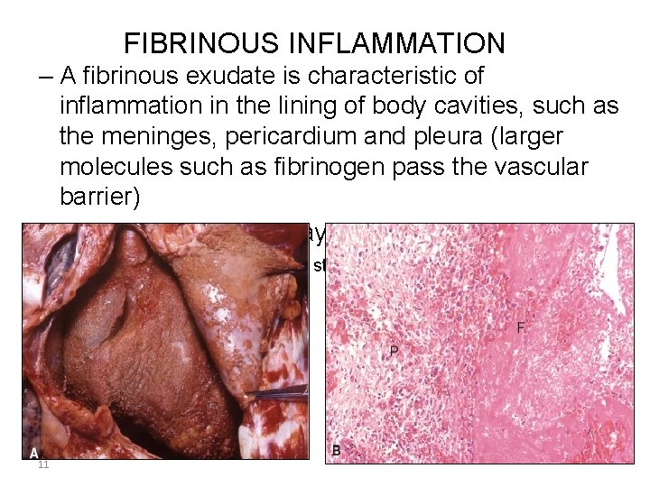 FIBRINOUS INFLAMMATION – A fibrinous exudate is characteristic of inflammation in the lining of