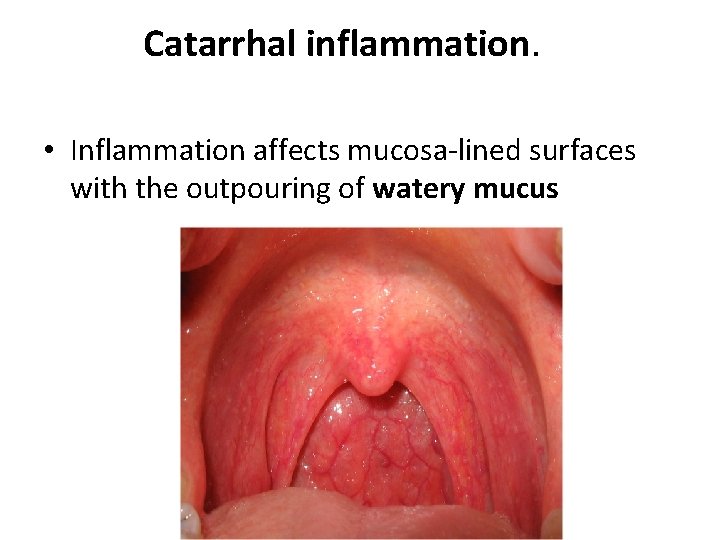 Catarrhal inflammation. • Inflammation affects mucosa-lined surfaces with the outpouring of watery mucus 