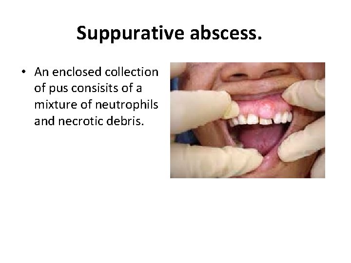 Suppurative abscess. • An enclosed collection of pus consisits of a mixture of neutrophils