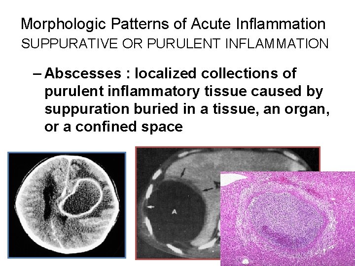 Morphologic Patterns of Acute Inflammation SUPPURATIVE OR PURULENT INFLAMMATION – Abscesses : localized collections