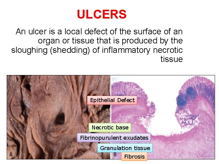 ULCERS An ulcer is a local defect of the surface of an organ or