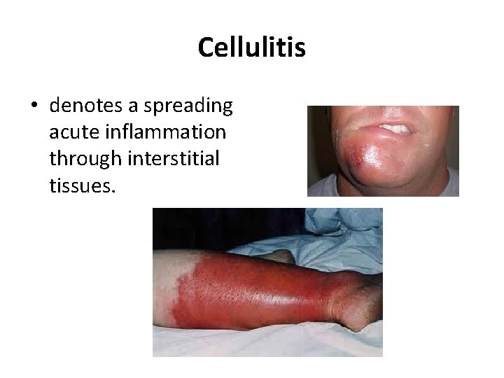 Cellulitis • denotes a spreading acute inflammation through interstitial tissues. 