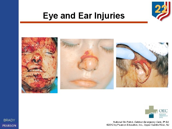 Eye and Ear Injuries BRADY National Ski Patrol, Outdoor Emergency Care, 5 th Ed