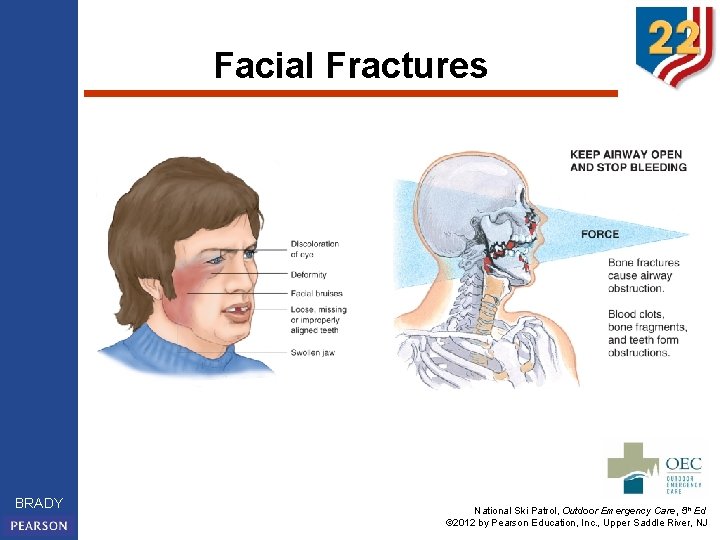 Facial Fractures BRADY National Ski Patrol, Outdoor Emergency Care, 5 th Ed © 2012