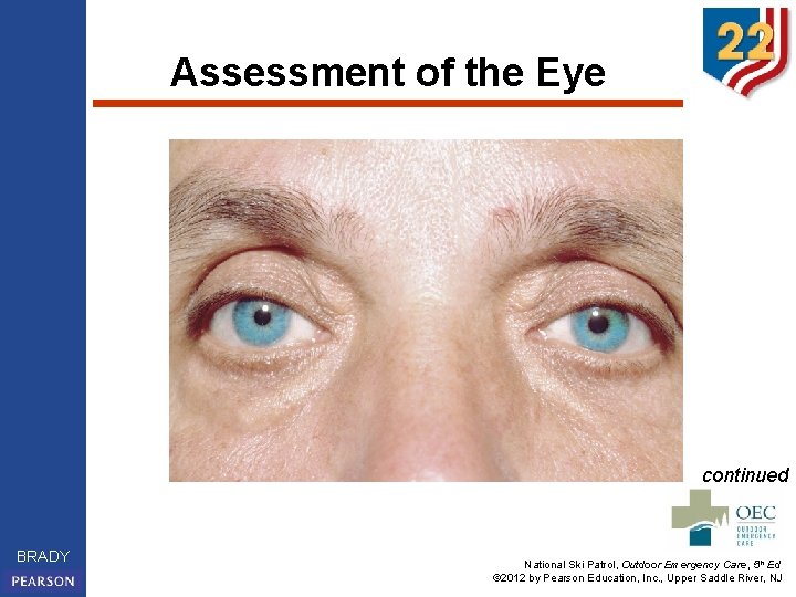 Assessment of the Eye continued BRADY National Ski Patrol, Outdoor Emergency Care, 5 th