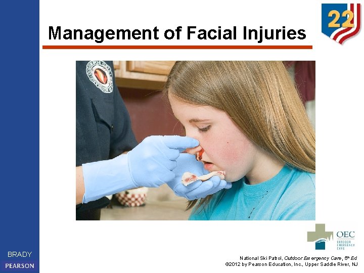 Management of Facial Injuries BRADY National Ski Patrol, Outdoor Emergency Care, 5 th Ed