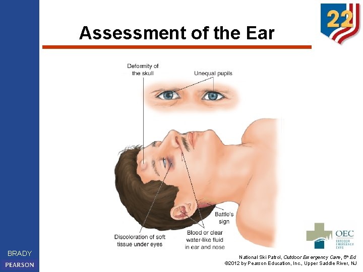 Assessment of the Ear BRADY National Ski Patrol, Outdoor Emergency Care, 5 th Ed