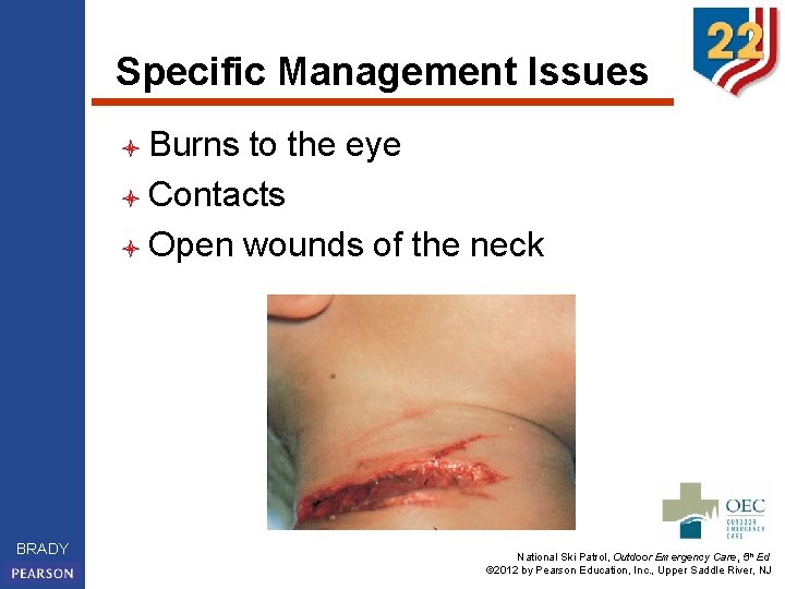 Specific Management Issues l Burns to the eye l Contacts l Open wounds of