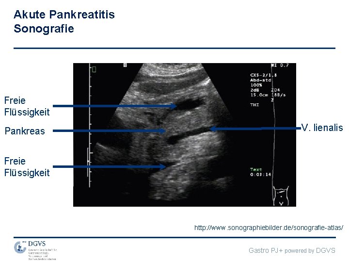 Akute Pankreatitis Sonografie Freie Flüssigkeit Pankreas V. lienalis Freie Flüssigkeit http: //www. sonographiebilder. de/sonografie-atlas/