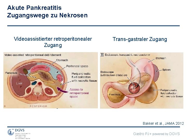 Akute Pankreatitis Zugangswege zu Nekrosen Videoassistierter retroperitonealer Zugang nach 20 Tagen Trans-gastraler Zugang nach