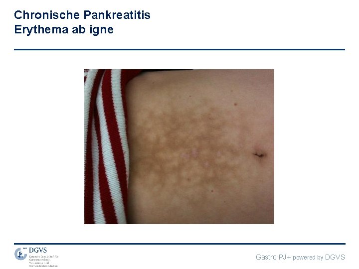 Chronische Pankreatitis Erythema ab igne Gastro PJ+ powered by DGVS 