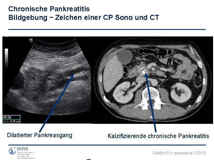 Chronische Pankreatitis Bildgebung – Zeichen einer CP Sono und CT Dilatierter Pankreasgang Kalzifizierende chronische