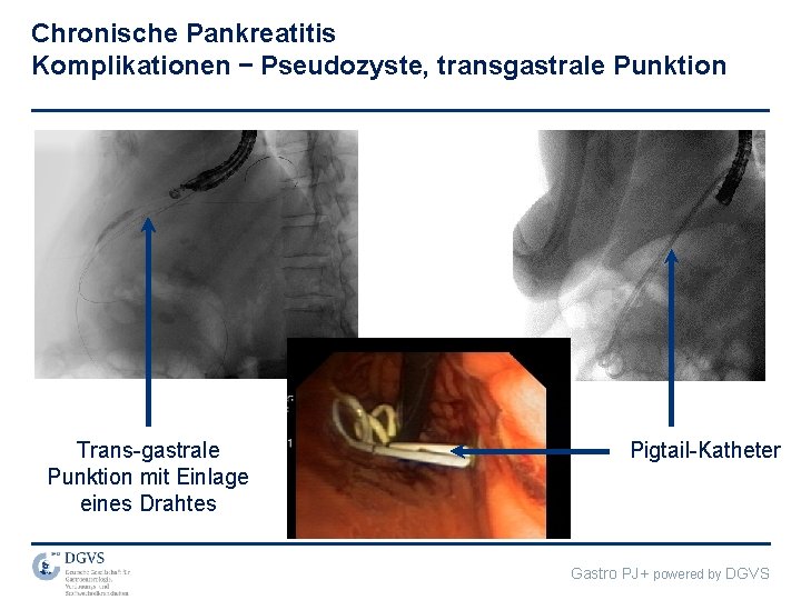 Chronische Pankreatitis Komplikationen – Pseudozyste, transgastrale Punktion Trans-gastrale Punktion mit Einlage eines Drahtes Pigtail-Katheter