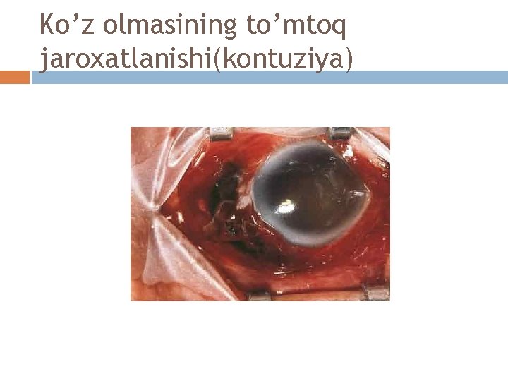 Ko’z olmasining to’mtoq jaroxatlanishi(kontuziya) 