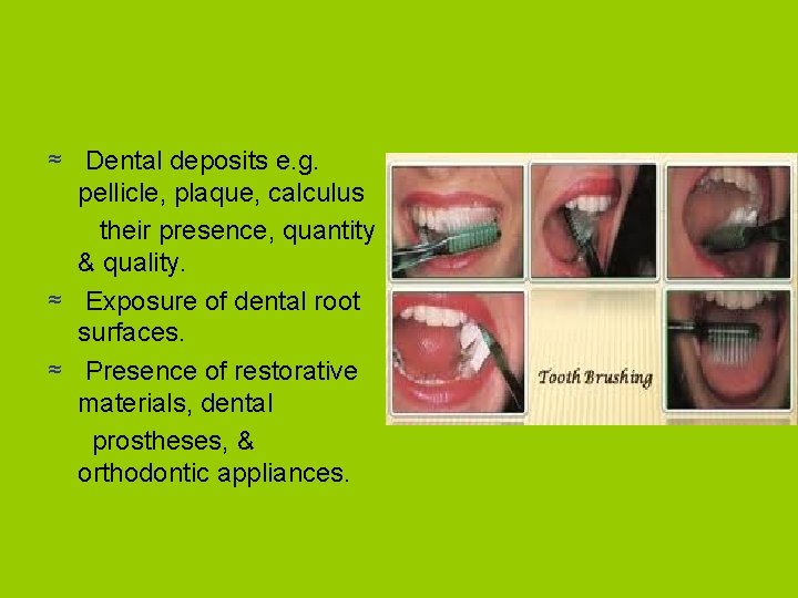 ≈ Dental deposits e. g. pellicle, plaque, calculus their presence, quantity & quality. ≈