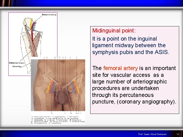 Midinguinal point: It is a point on the inguinal ligament midway between the symphysis