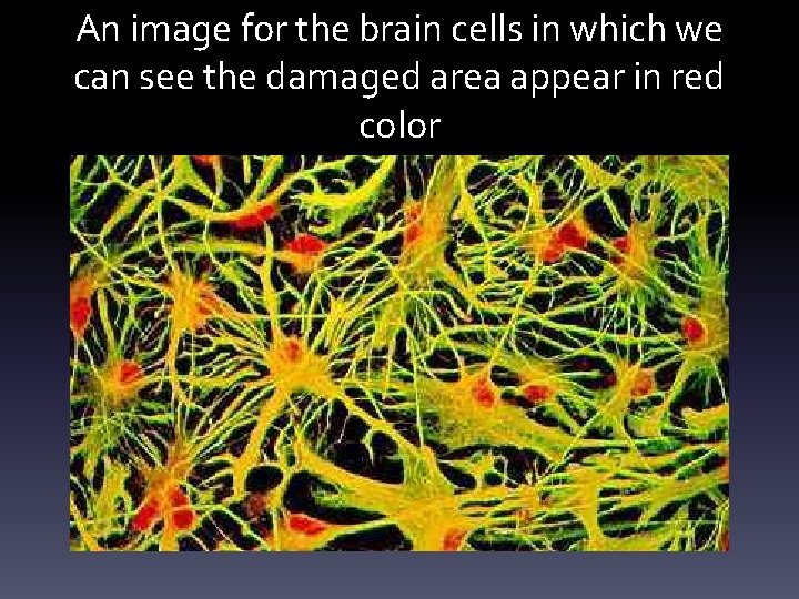 An image for the brain cells in which we can see the damaged area