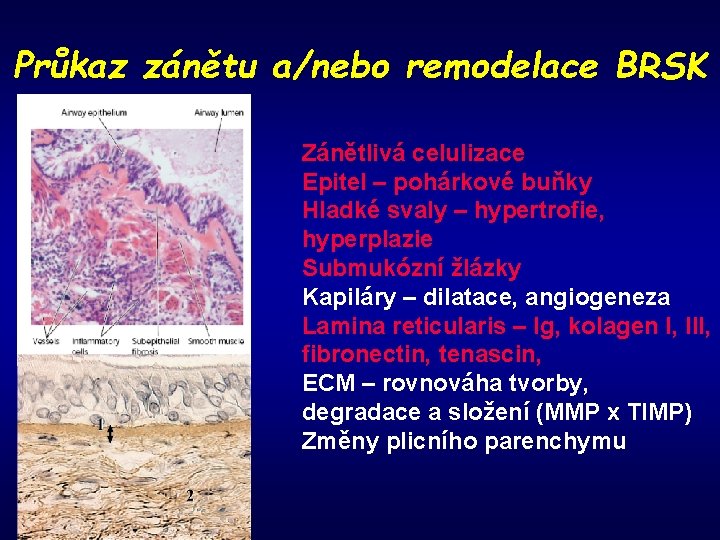 Průkaz zánětu a/nebo remodelace BRSK Zánětlivá celulizace Epitel – pohárkové buňky Hladké svaly –