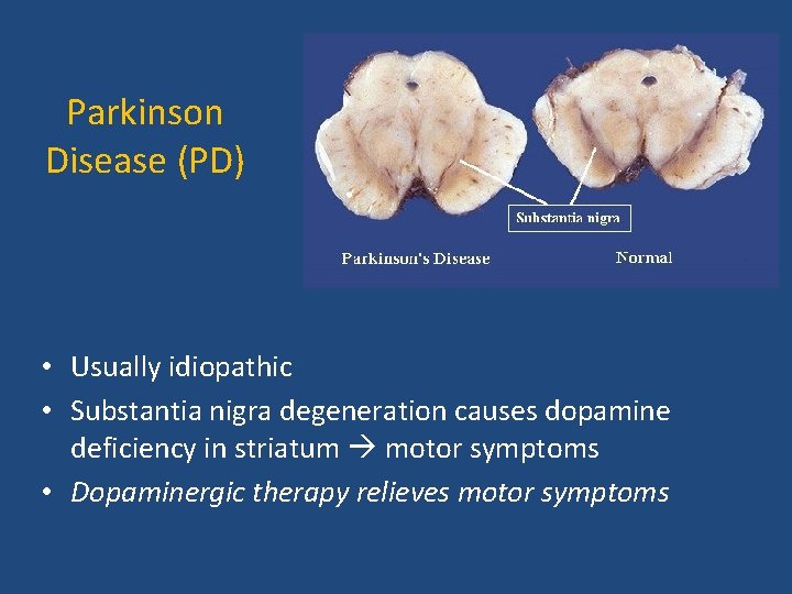 Parkinson Disease (PD) • Usually idiopathic • Substantia nigra degeneration causes dopamine deficiency in