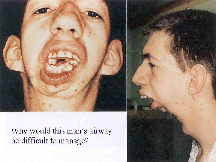Why would this man’s airway be difficult to manage? 
