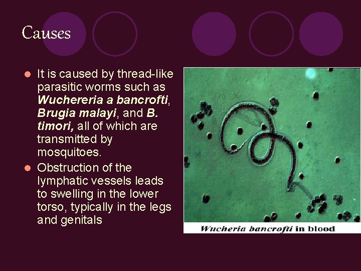 Causes It is caused by thread-like parasitic worms such as Wuchereria a bancrofti, Brugia