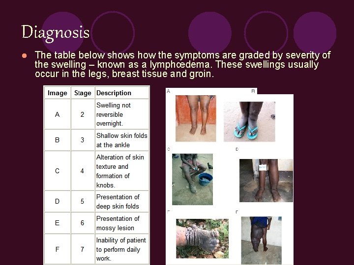 Diagnosis l The table below shows how the symptoms are graded by severity of