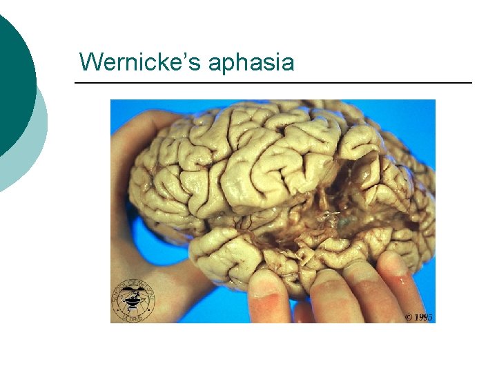 Wernicke’s aphasia 