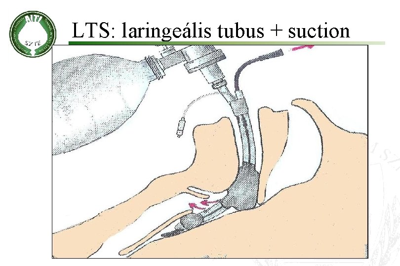 LTS: laringeális tubus + suction 