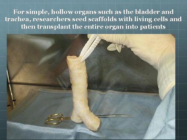 For simple, hollow organs such as the bladder and trachea, researchers seed scaffolds with