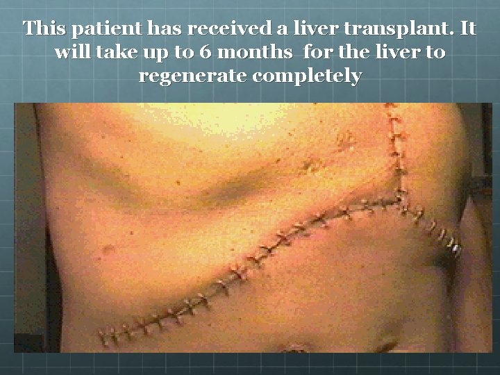 This patient has received a liver transplant. It will take up to 6 months