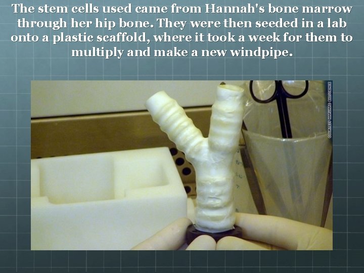 The stem cells used came from Hannah's bone marrow through her hip bone. They