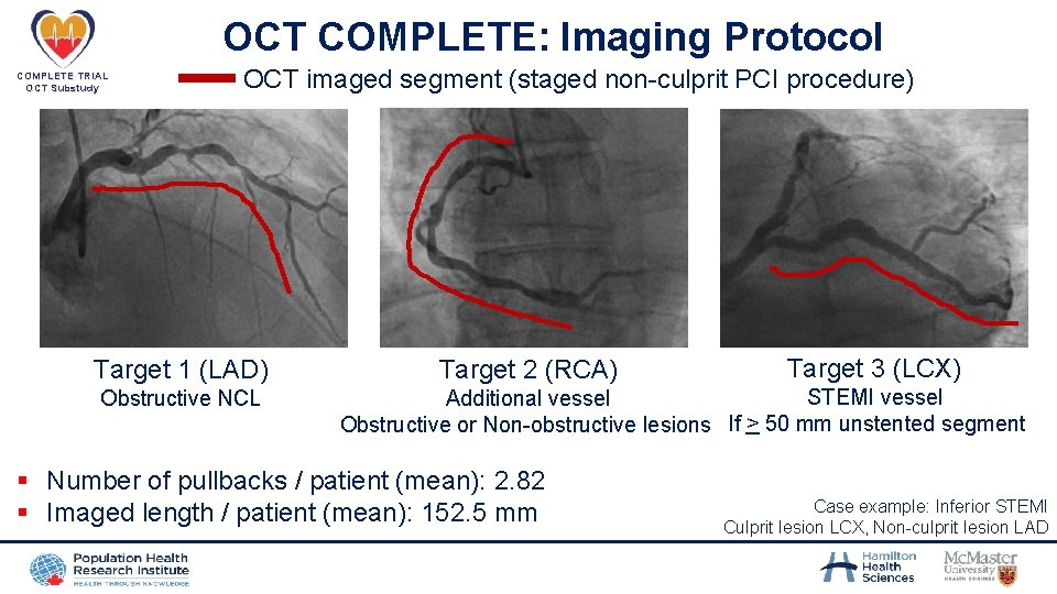 OCT COMPLETE: Imaging Protocol COMPLETE TRIAL OCT Substudy OCT imaged segment (staged non-culprit PCI