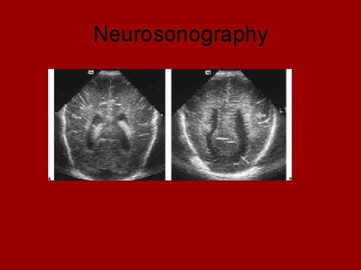 Neurosonography 