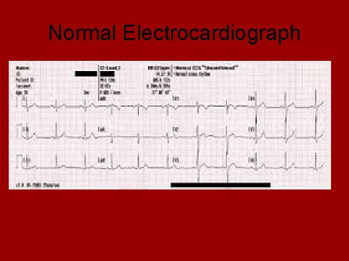 Normal Electrocardiograph 