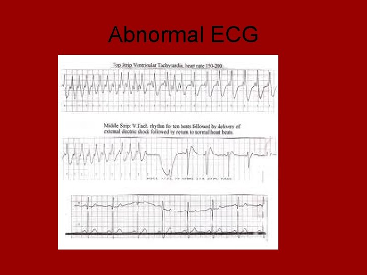 Abnormal ECG 