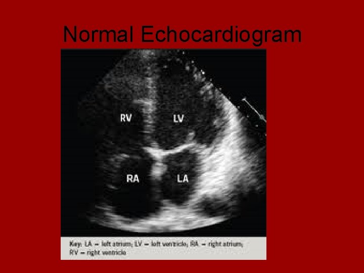 Normal Echocardiogram 