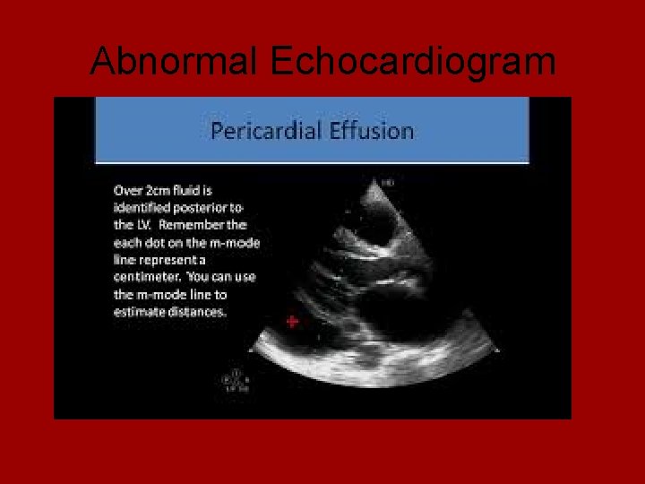 Abnormal Echocardiogram 