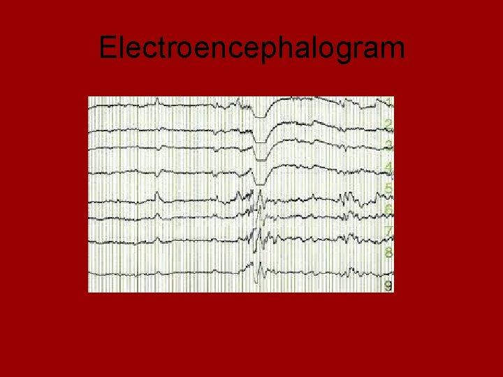 Electroencephalogram 