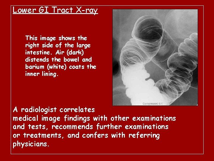 Lower GI Tract X-ray This image shows the right side of the large intestine.