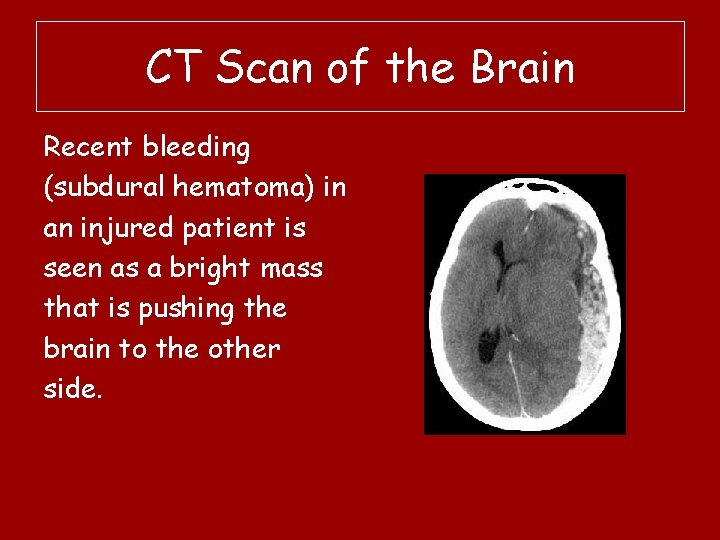 CT Scan of the Brain Recent bleeding (subdural hematoma) in an injured patient is
