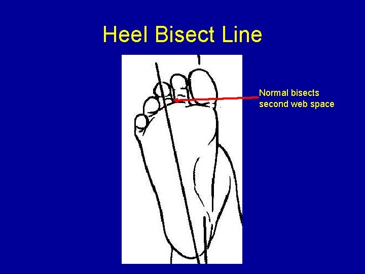 Heel Bisect Line Normal bisects second web space 