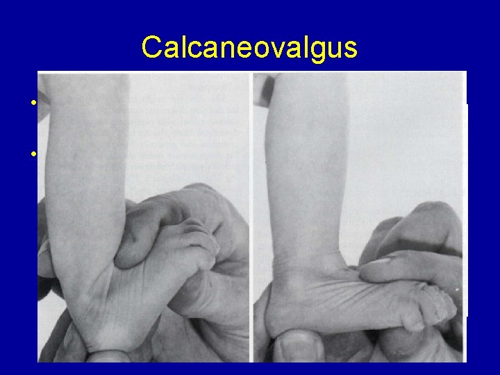 Calcaneovalgus • Maybe most common foot deformity • Estimated to be. 1% up to