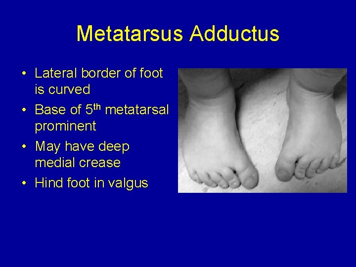 Metatarsus Adductus • Lateral border of foot is curved • Base of 5 th