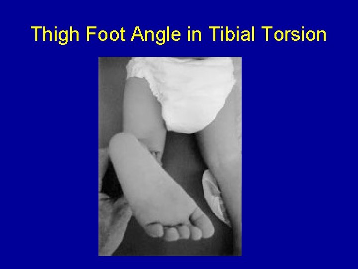 Thigh Foot Angle in Tibial Torsion 