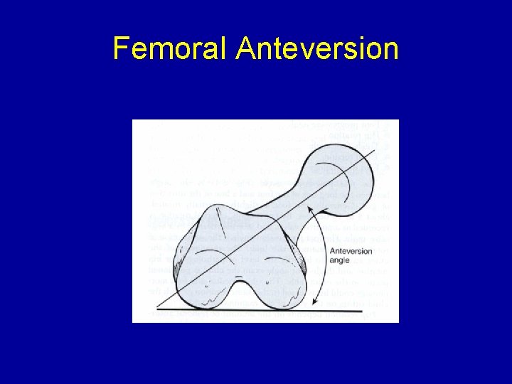 Femoral Anteversion 